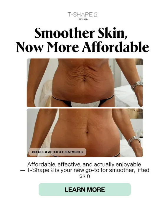 Radiofrequency treatment being applied