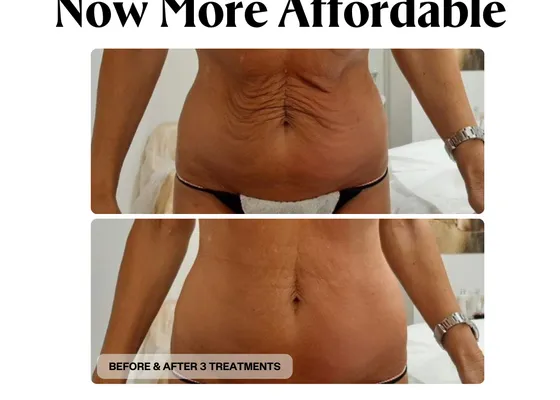 Radiofrequency treatment being applied