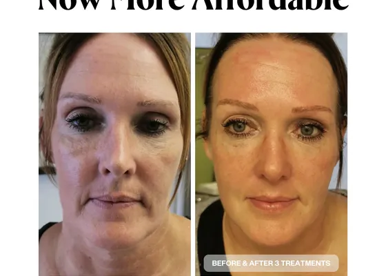 Low-level laser therapy treatment