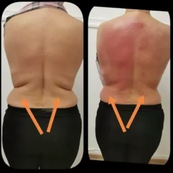 Before and after T-Shape 2 treatment