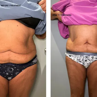 Before and after T-Shape 2 treatment