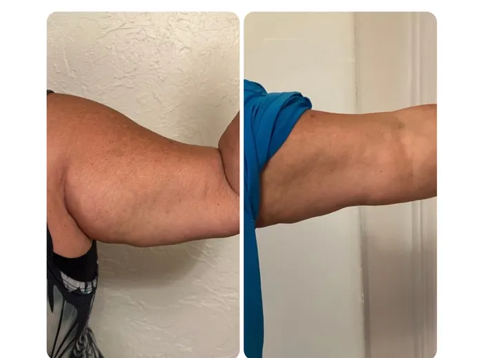 Before and after T-Shape 2 treatment