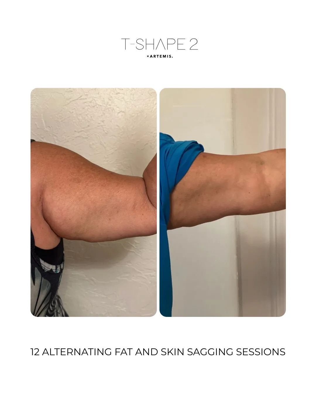 T-Shape 2 before and after results on the upper arm after 12 sessions