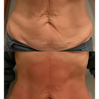 Before and after T-Shape 2 treatment