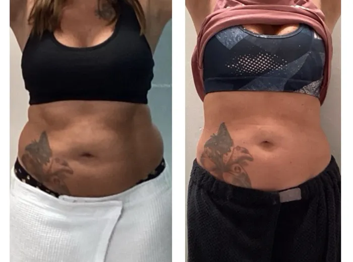 Before and after T-Shape 2 treatment