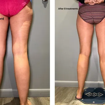 Before and after T-Shape 2 treatment
