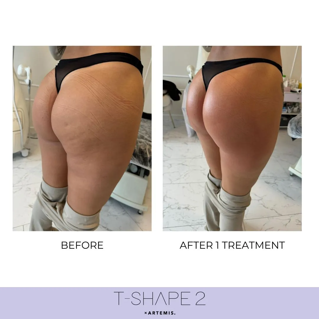T-Shape 2 body sculpting before and after results on the buttocks and thighs after 1 treatment
