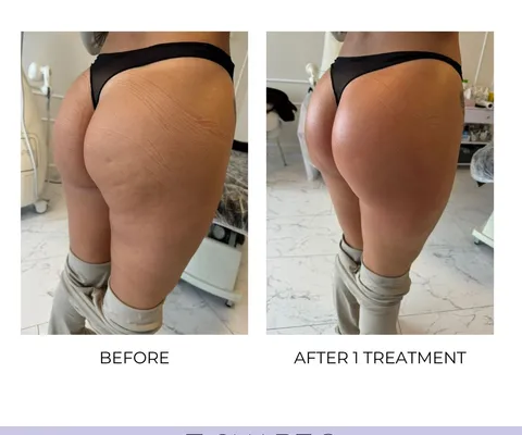 T-Shape 2 treatment results