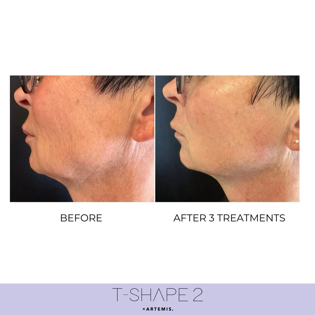T-Shape 2 skin tightening before and after results on the jawline and neck after 3 treatments
